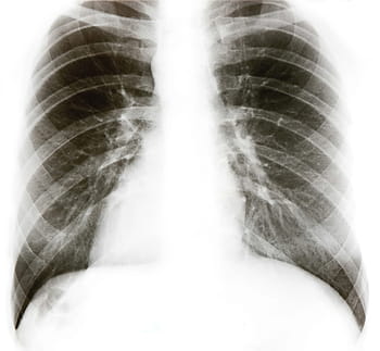 x, ray, chest, xray, health, care, medical, x-ray, background, white, hospital